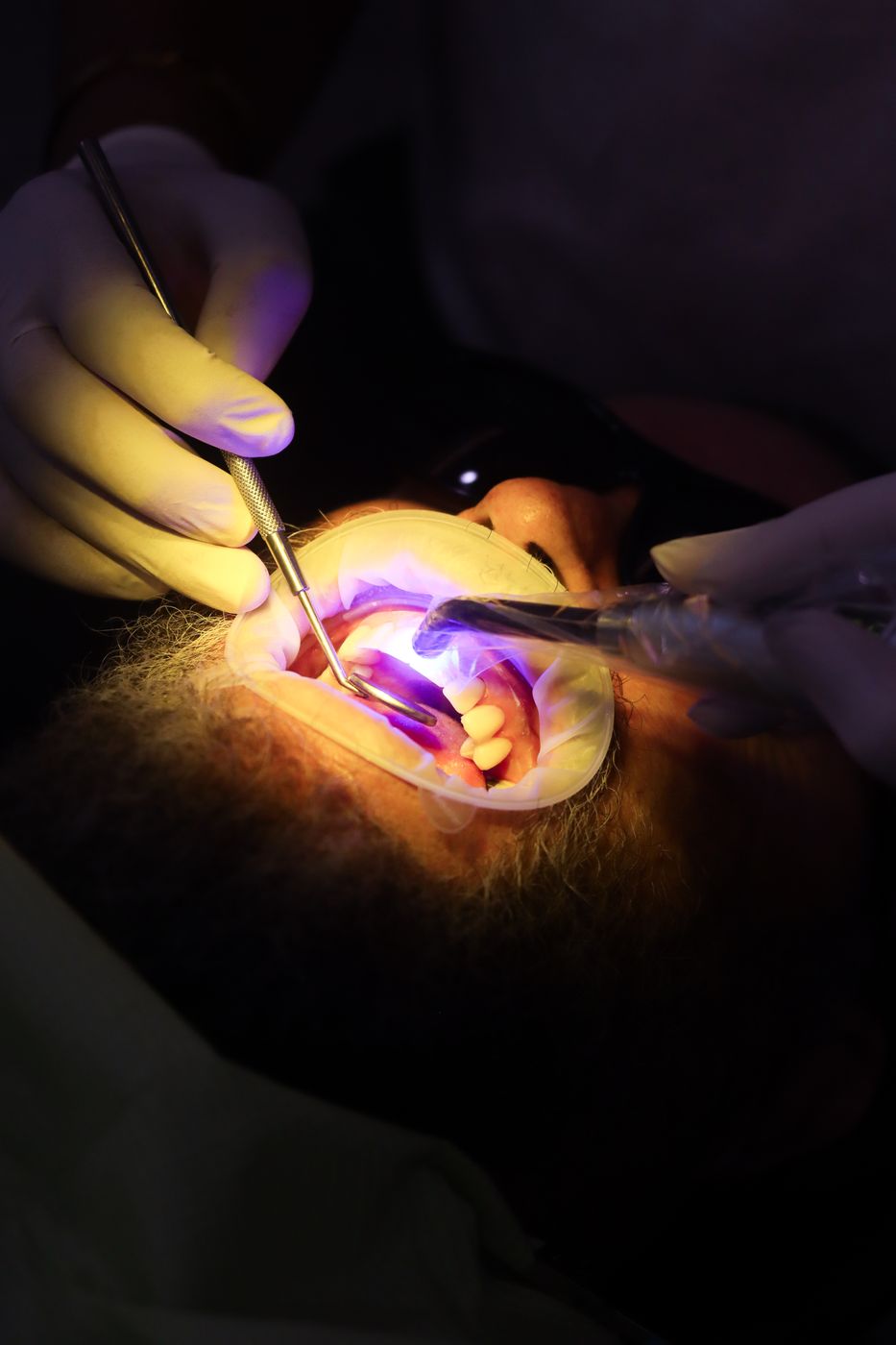 Clinical procedure under a curing light