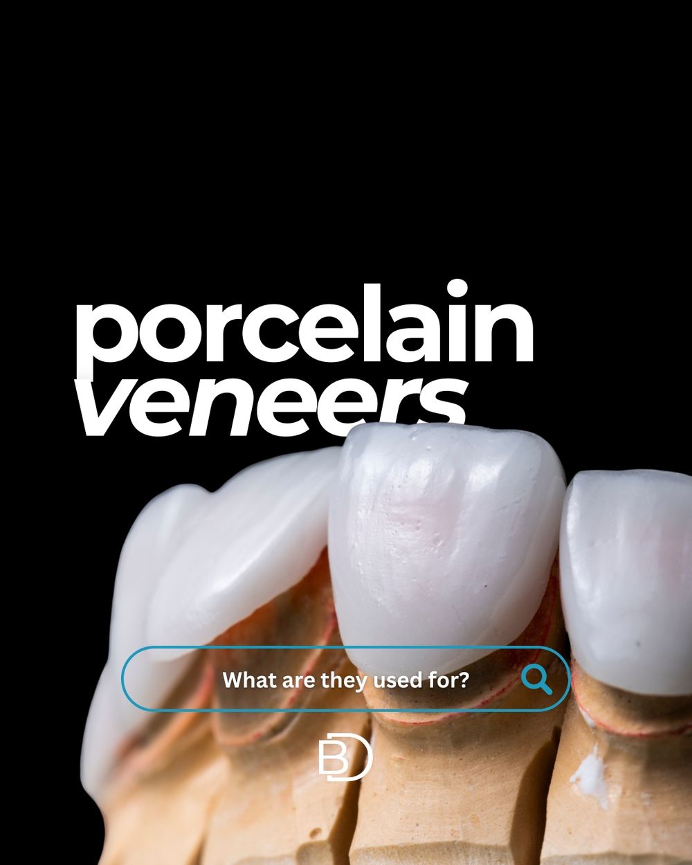 Porcelain veneers post